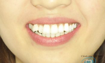 niềng răng mắc cài mặt trong 1