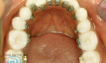 niềng răng mắc cài mặt trong