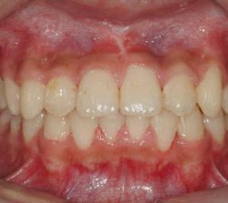 niềng răng mặt trong khớp răng sâu cười hở lợi 2