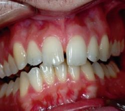 niềng răng mặt trong khớp răng khấp khểnh 1