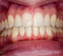 niềng răng mặt trong khớp răng khấp khểnh 2