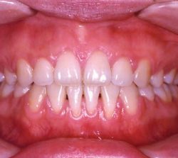 niềng răng mặt trong khớp hở hàm 2