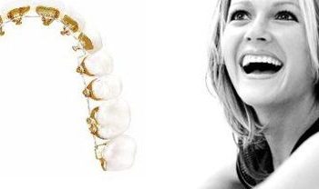 niềng răng mắc cài mặt lưỡi tại hà nội có nguy hiểm không