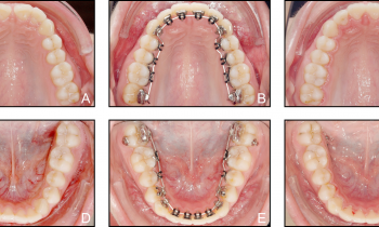 chỉnh nha mat lươi giá rẻ hà nội