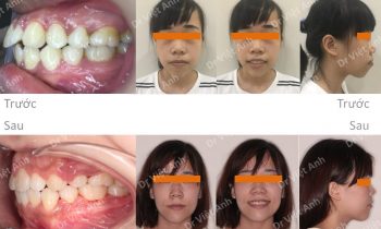 Niềng răng hô, cằm lẹm