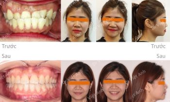 niềng răng mắc cài pha lê