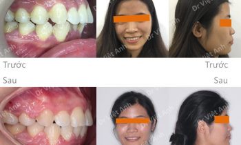 chỉnh nha việt anh